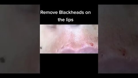 Remove Blackheads around the Lips 💋