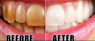 NATURAL TEETH WHITENER