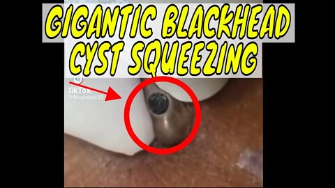 Gigantic blackhead cyst squeezing 😨 #blackheadremoval #blackhead #blackheads #cyst #cystremoval