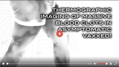 Thermographic Imaging Shows Massive Blood Clots in Asymptomatic Vaxxed!