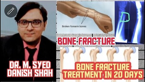 Fracture Treatment | Homeopathic Medicine for Fracture | ہدیوں کا ٹوٹنا اور اس کا علاج