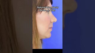 Rhinoplasty before & after