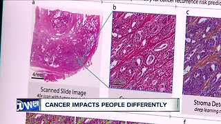 Artificial intelligence could help tailor game-changing prostate cancer treatment