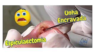 Espiculaectomia = UNHA dentro da PELE #unhas #pes #dor #podologia #unhaencravada #procedimento #102