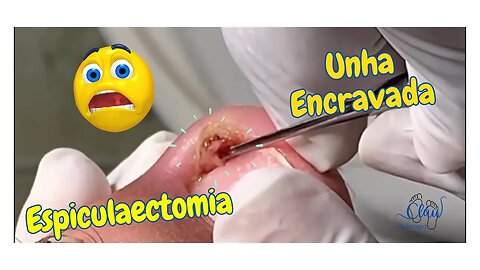 Espiculaectomia = UNHA dentro da PELE #unhas #pes #dor #podologia #unhaencravada #procedimento #102