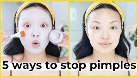 5 Way To Stop Acne & Pimples FAST!