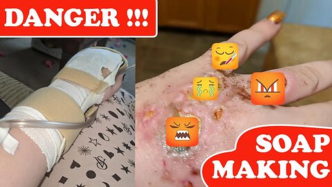 Dangers in DIY Soap Making ~ What Beginners MUST know ~ Burn Images