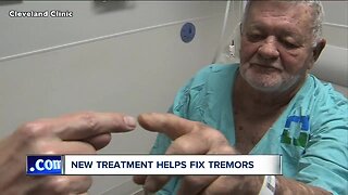 Strongsville grandfather is one of the first to receive new non-invasive treatment to cure tremor