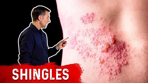 Shingles: Natural Relief