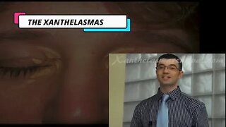 THE XANTHELASMAS