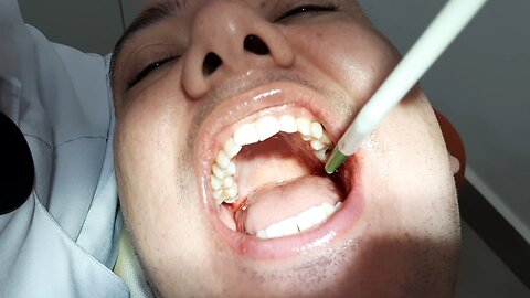 Dental surgery - Wisdom tooth extraction - Dentist Brazil