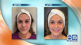 Turn Back Time Spa & Wellness Clinic demonstrates their new skin resurfacing treatment called Coolpeel