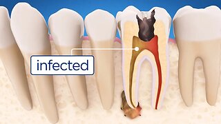 Steps for a Root Canal Procedure {by Dr. Domenico Ricucci}