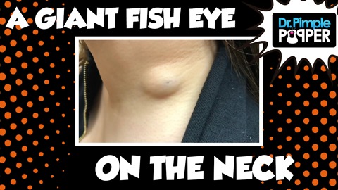 A Giant Fish Eye Cyst on The Neck