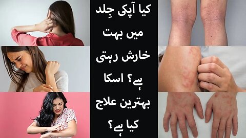 Atopic Dermatitis Urdu video