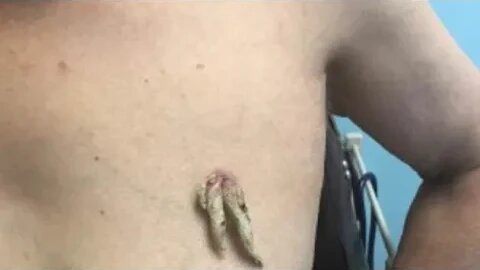 Malaysian woman, 63, develops a 5cm-long 'HORN' on her breast after rare case of itchy viral warts.