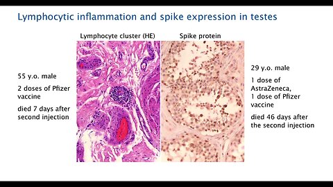 ⚠️ An ALARMING finding: Spike protein expression in the testes At a conference in early 2023