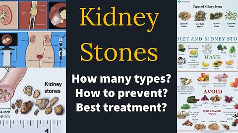 Kidney stones symptoms, causes, diagnosis & treatment
