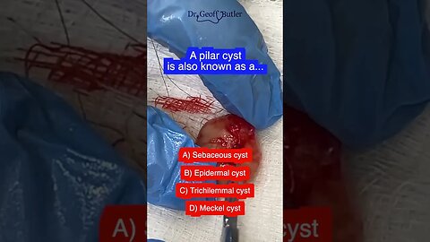 POP Quiz: Pilar Cysts