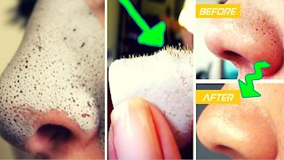 Easy Way to Remove Blackheads Naturally