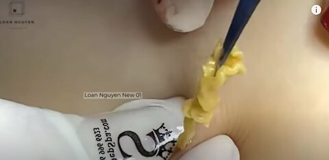 Deep Cysts and Blackheads Removal On Cheek , pimple popping videos 2021 blackheads