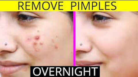 Massive Pimple Explosion. LipomaCyst.com. Dr juniorRendaDireta