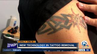 ReversaTatt: New technology helping people eliminate unwanted tattoos