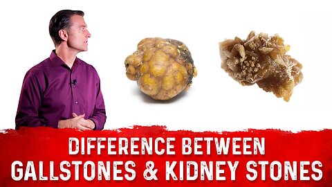 The Big Difference Between Gallstones & Kidney Stones – Dr. Berg