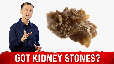 Treatment For Kidney Stone & Kidney Stone Prevention – Dr. Berg