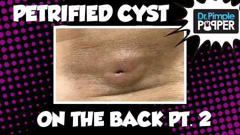 A Truly Petrified Cyst: Part 2!