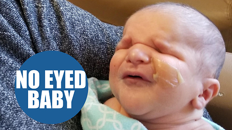 Parents shocked when told their new baby is born without eyes