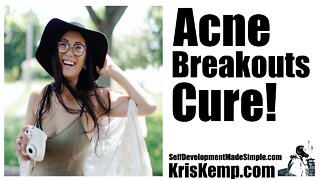 Acne breakouts Cure! You need this now! An easy cure that works!
