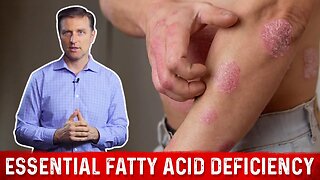 Fatty Acids (Omega-3 and Omega-6) Deficiency: Symptoms and Sources by Dr.Berg