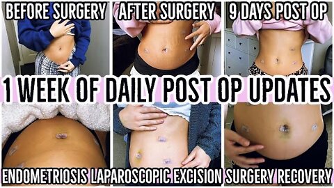 A WEEK OF POSTOP RECOVERY UPDATES 2021|WHAT TO EXPECT RECOVERING FROM ENDOMETRIOSIS SURGERY|ez tingz