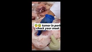 Tumor