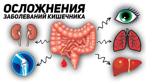 Эти проблемы со здоровьем могут возникнуть у людей с больным кишечником