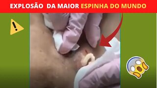 Removendo Espinhas Inflamadas Muito Satisfatório Cravos e Espinhas -inflamed pimple and blackheads