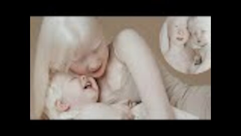 Albino sisters born 12 years apart become modeling sensations