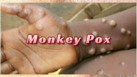 What Is MonkeyPox? 🙊