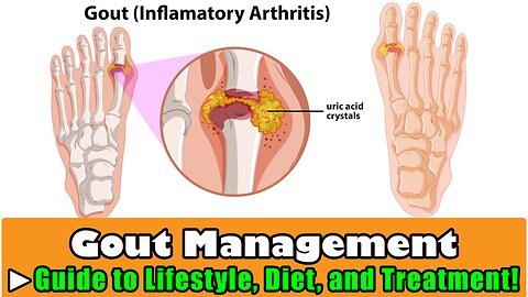 Gout Management: A Comprehensive Guide to Lifestyle, Diet, and Treatment