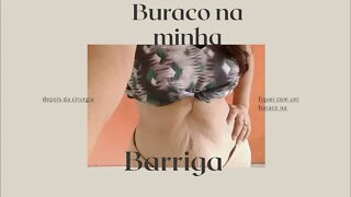 Depois da cirurgia da Hérnia fiquei com buraco na barriga. Um mês de pós operatório da hérnia...