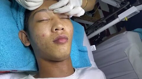 Giant blackheads! Blackheads and pimples removal/extraction! Satisfactory Big Cystic Acne Whiteheads