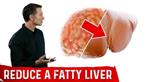The Best Fatty Liver Exercise – Treatment of Fatty Liver – Dr.Berg