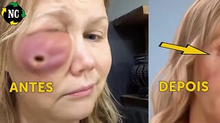 Esta mulher ficou com um grande buraco no rosto após uma “falha médica”. Mas como ela está agora...