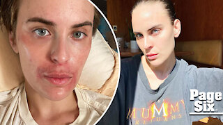 Tallulah Willis shares before-and-after photos of skin transformation