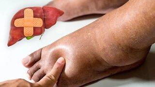 6 Signs of Liver Problems Hidden On Your Feet