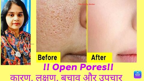 open pores|रोम छिद्र | skin में गड्ढों का इलाज