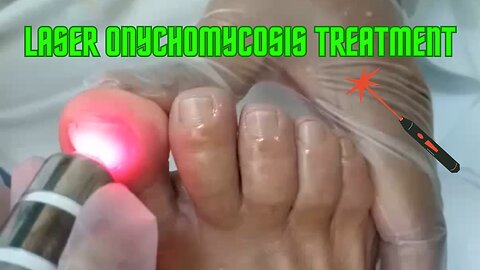 Laser Onychomycosis Treatment