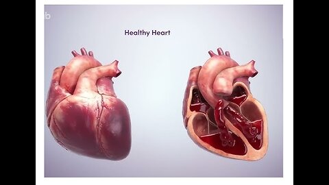 Transcatheter Medical Device for Treating Heart Failure - 3D Animation