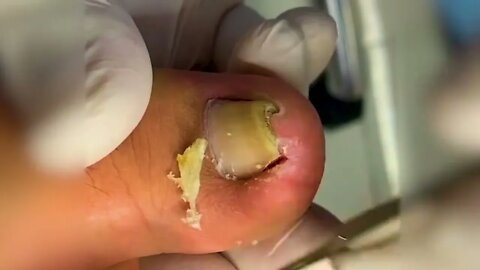 Manicure Unclogging the toenail Solve your problem #6 | 2022 Video
